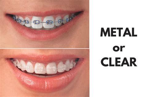 clear bracket braces vs metal|difference between aligners and braces.